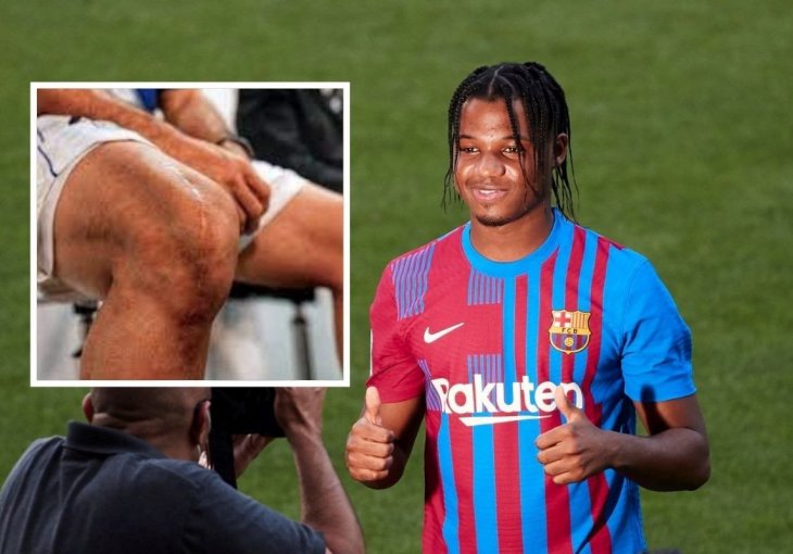 SREĆA DA UOPŠTE MOŽE OPET IGRATI Fotografije pokazuju jeziv ožiljak na koljenu Ansua Fatija koji neodoljivo podsjeća na Ronalda