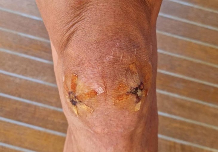 Po mnogim najbolji napadač današnjice, ovako izgleda njegovo koljeno nakon saniranja povrede