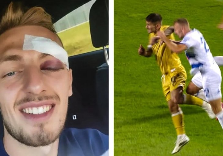 (FOTO) Ovako izgleda oko stopera Osijeka dan nakon što ga je igrač Hajduka udario laktom