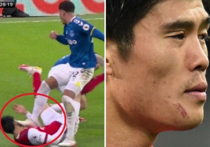 BRUTALNO! NOGOM DIRTEKTNO U LICE! Igrač Evertona ZGAZIO Japanca iz Arsenala: Namjerno je to uradio! (VIDEO)