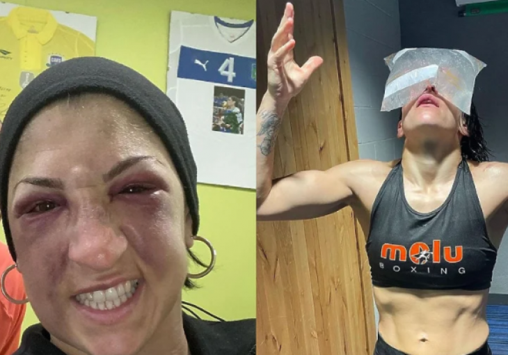 Španska bokserka objavila fotografije s tretmana oporavka nakon 236 primljenih udarca