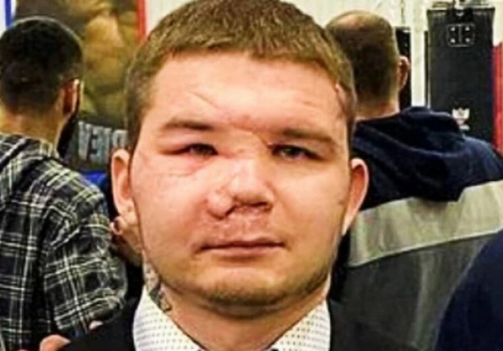 Ruski borac Medvedev će nakon napada medvjeda biti podvrgnut operacijama rekonstrukcije lica