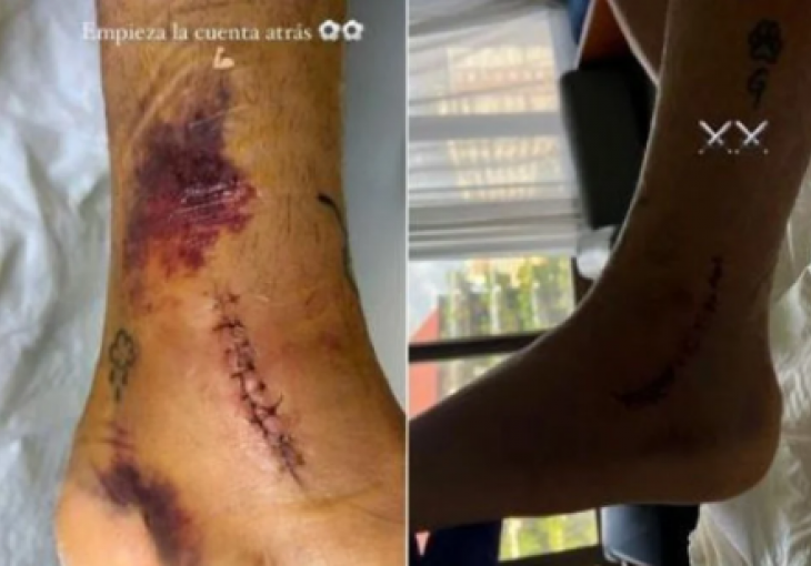 ZASTRAŠUJUĆE slike noge iskusnog španskog igrača nakon teške povrede